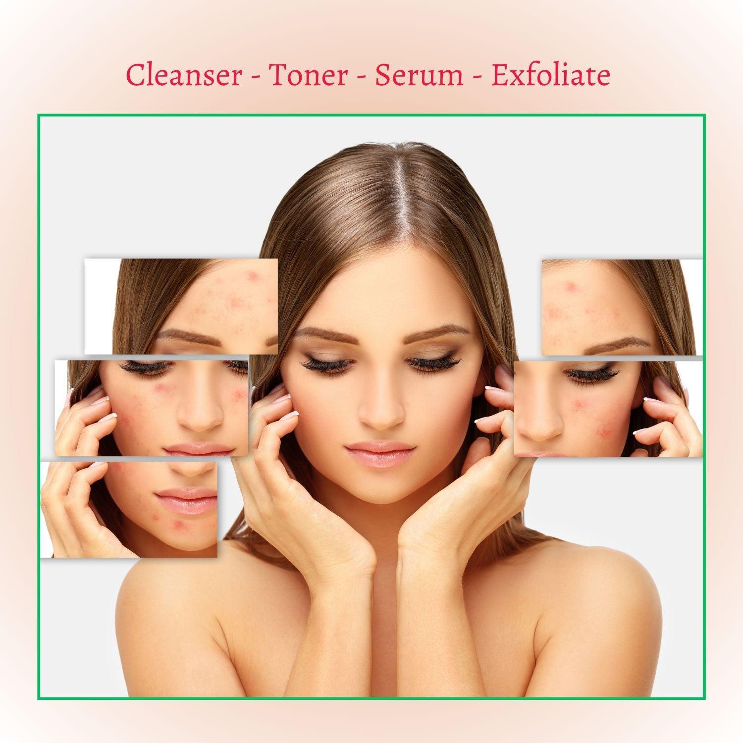 Perfect Trifecta Acne Peel by gymsegbë