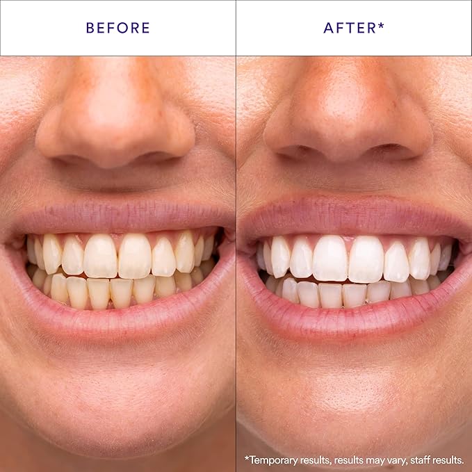 Purple Teeth Whitening Strips – Gentle Daily Purple Whitening Strips for Surface Stain Reduction & Natural Shine, Portable Whitening Strips Purple for Home or On-The-Go Use (14) DestGlow