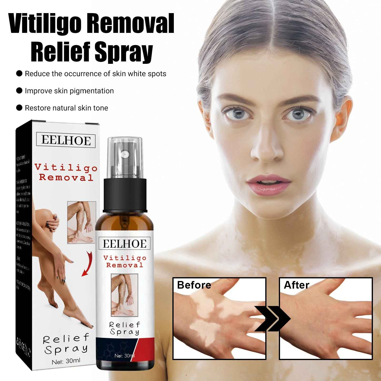 Vitiligo Removal Relief Spray, Repair Whitening Spot Perspiration Beauty Moisturizing Skin Care spray