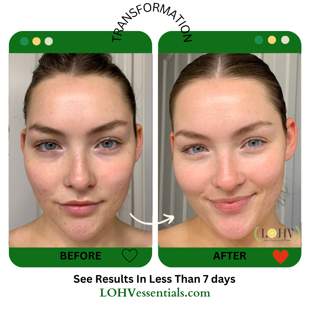 PREMIUM 100% VEGAN HYPER HYDRATOR Face Moisturizer With SPF 30 + Hyaluronic Acid + Lactic acid + Vitamin C + Kombucha by LOHV ESSENTIALS