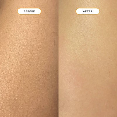 Nood Ingrown Hair Treatment The Eraser - New by This is Beauty US