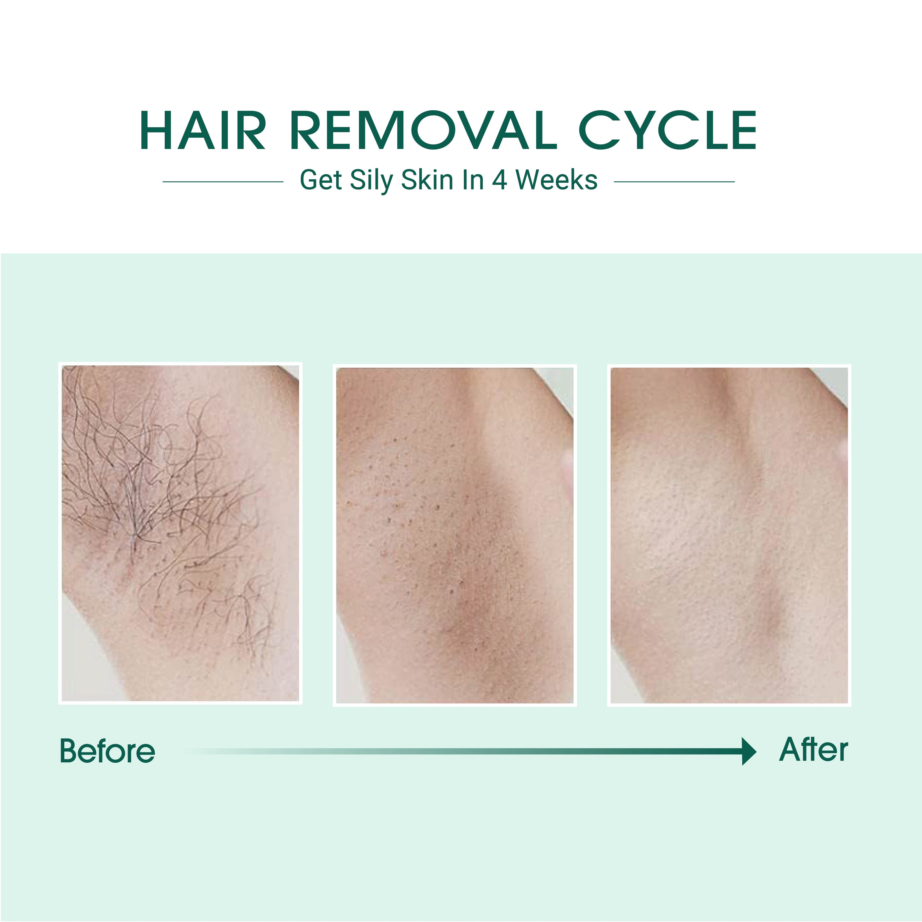 Laser IPL Hair Removal - DestGlow