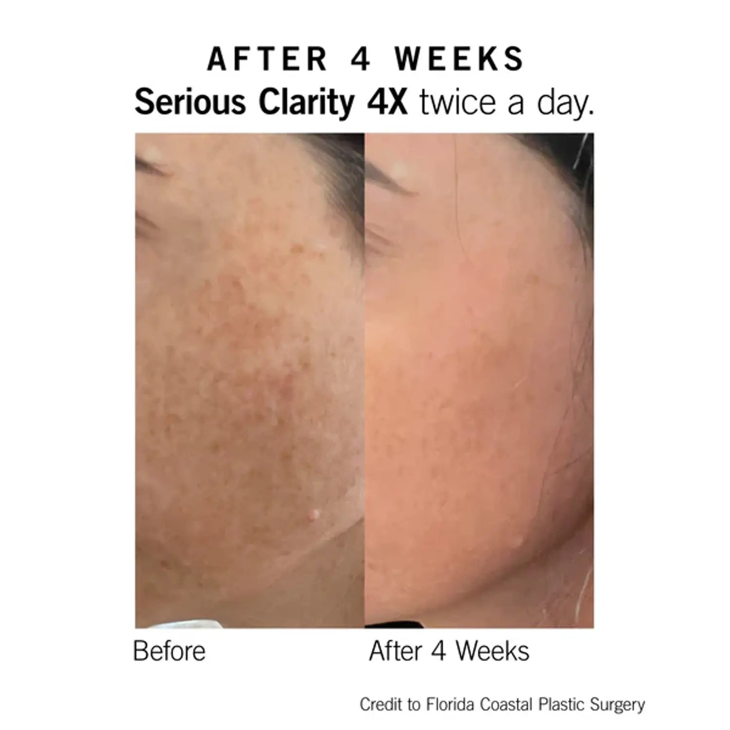 Neova Serious Clarity 4X 1 Oz by Nava Beauty