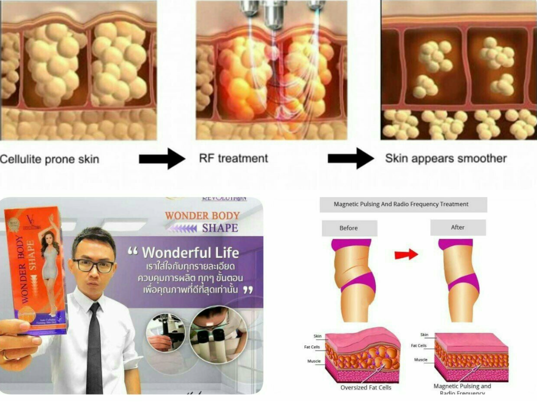 V2 Revolution Stretch Mark & Cellulite Solution