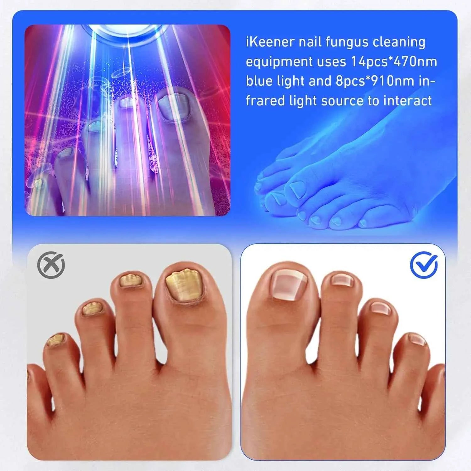 FungiClear™ Wireless Nail Fungus Laser – Foot Care & Nail Health