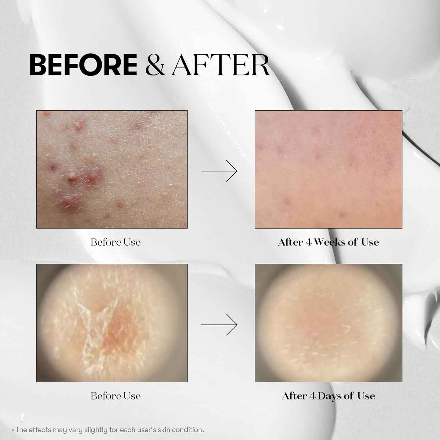 CICA Reedle Shot 100, Spicule Microneedling Serum for Pore Care &amp; Exfoliation, Exosome, Centella Asiatica for Glass Skin, Skin Texture, Korean Liquid Skin Booster (1.69 Fl Oz / 50Ml)