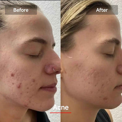 LED Red Light Therapy Mask