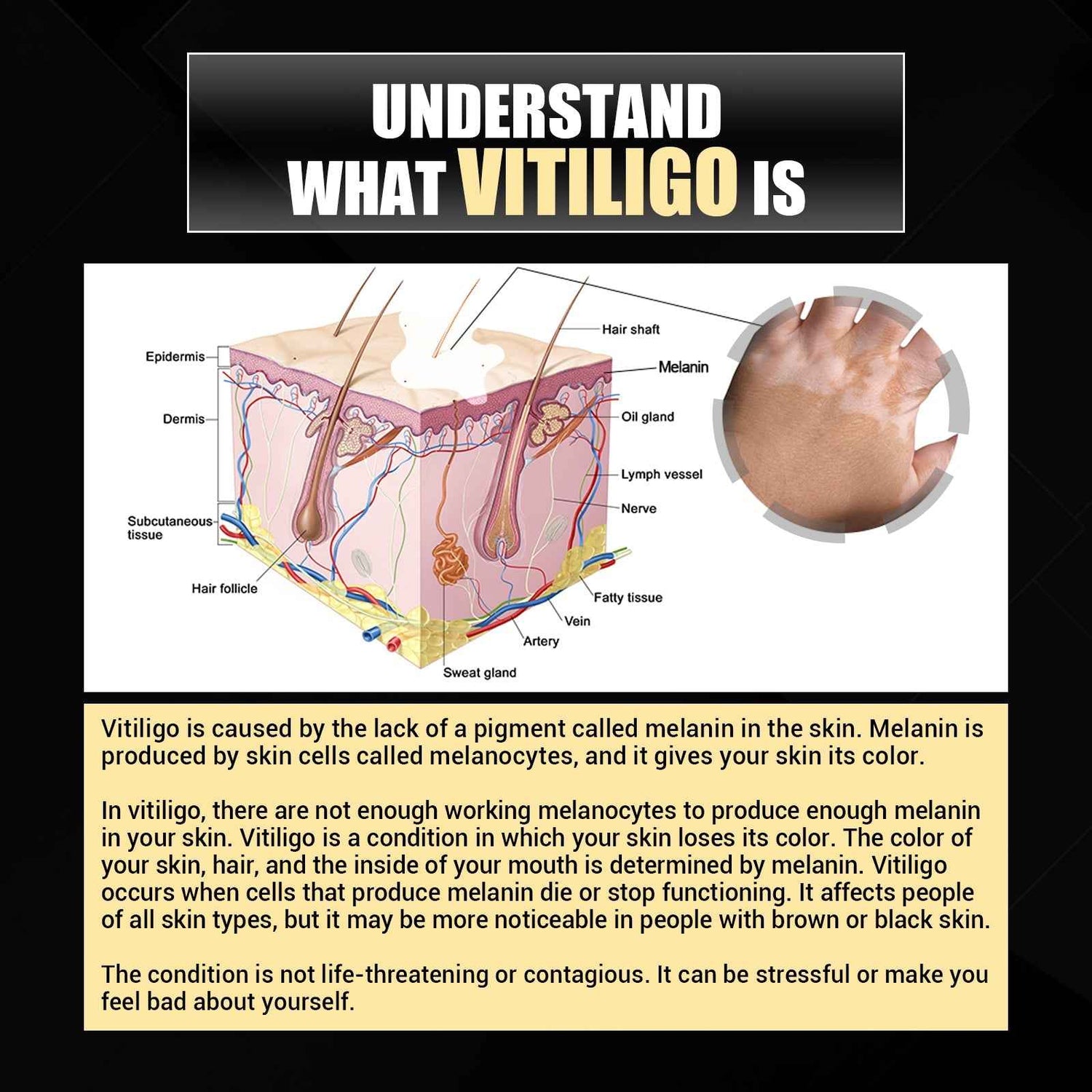 Vitiligo Removal Relief Spray, Repair Whitening Spot Perspiration Beauty Moisturizing Skin Care spray