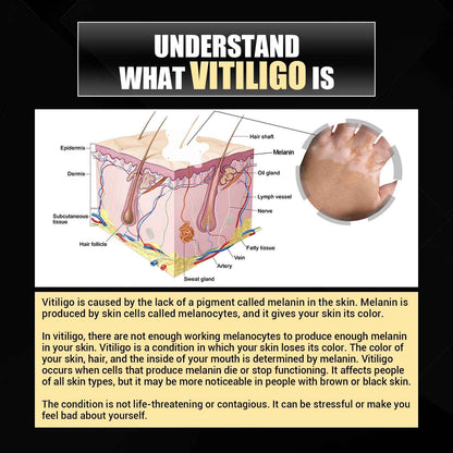 Vitiligo Removal Relief Spray, Repair Whitening Spot Perspiration Beauty Moisturizing Skin Care spray