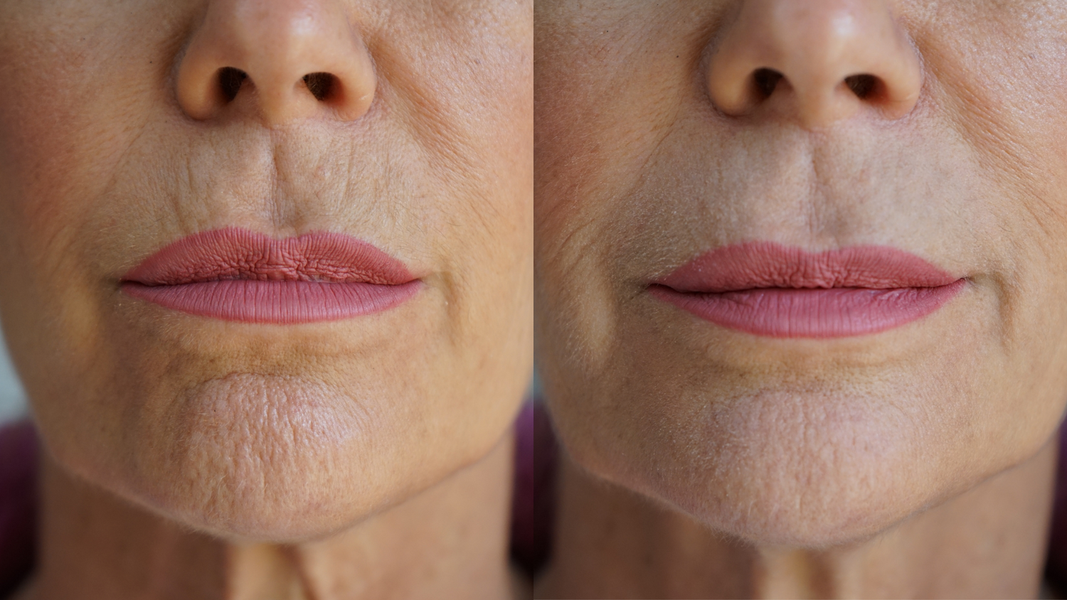 Ageless Lip &amp; Line Filler