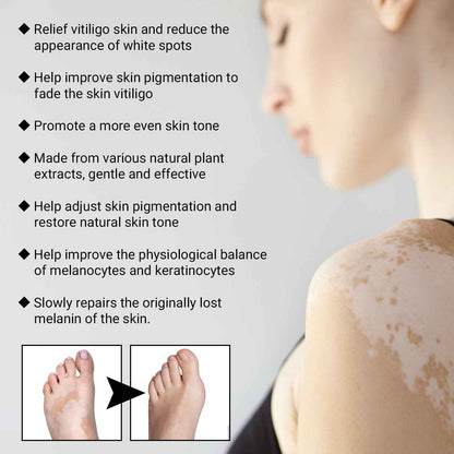 Vitiligo Removal Relief Spray, Repair Whitening Spot Perspiration Beauty Moisturizing Skin Care spray