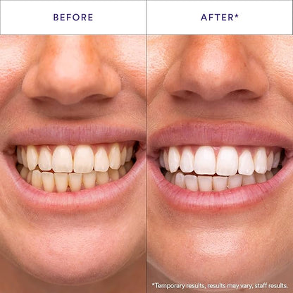 Purple Teeth Whitening Strips – Gentle Daily Purple Whitening Strips for Surface Stain Reduction &amp; Natural Shine, Portable Whitening Strips Purple for Home or On-The-Go Use (14) by VAH