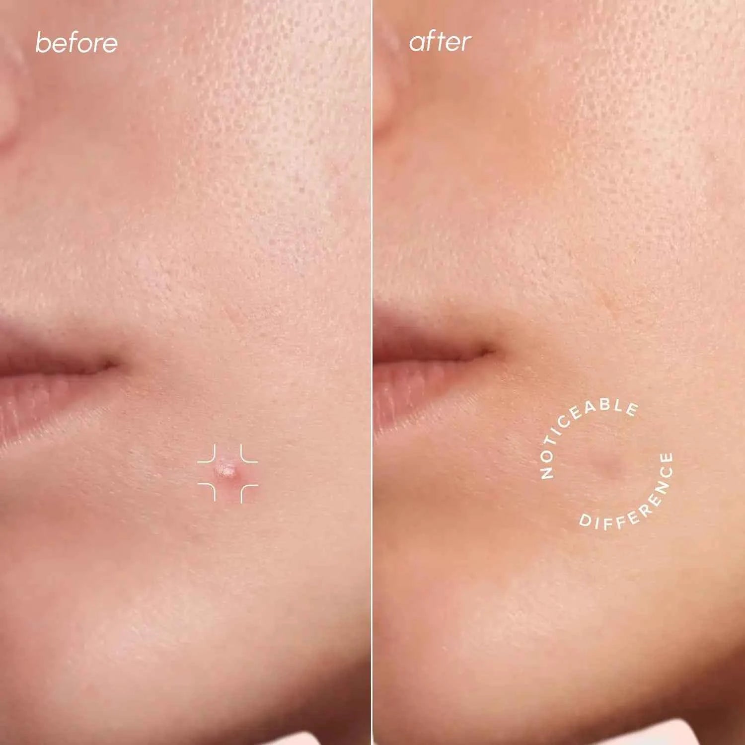 Invisible Pimple &amp; Acne Patches