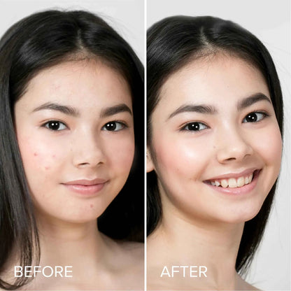 Pimple &amp; Acne Patches