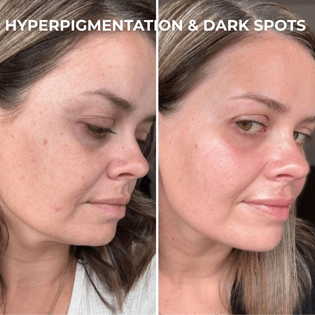 PDRN Collagen Peptide Hydrogel Mask by Skynflow