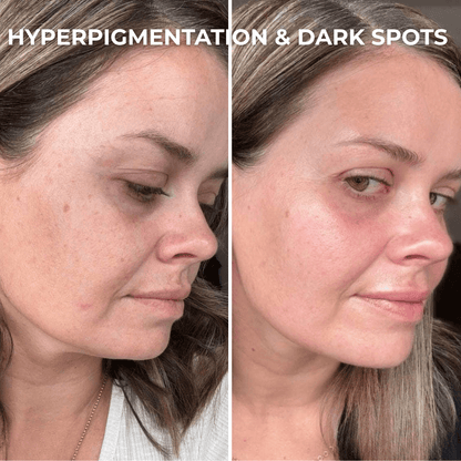 PDRN Collagen Peptide Hydrogel Mask by Skynflow