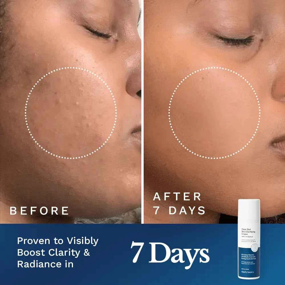 Clear Out Skin Clarifying Cream