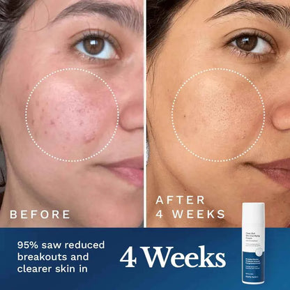 Clear Out Skin Clarifying Cream