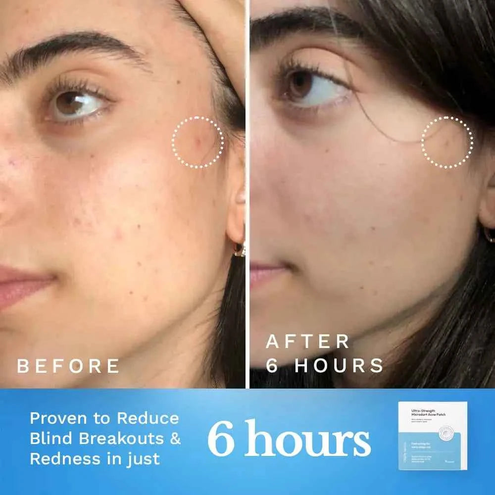 Ultra-Strength Microdart Acne Patch