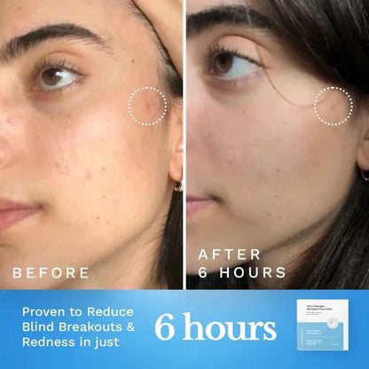 Ultra-Strength Microdart Acne Patch