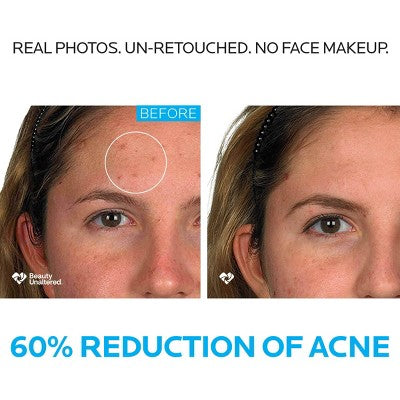 La Roche Posay Effaclar Dermatological Acne Treatment 3-Step System Kit Medicated Gel Cleanser 7.5 fl oz - Imperfect Box by This is Beauty US