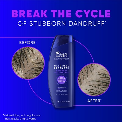 Head &amp; Shoulders Clinical Strength Anti-Dandruff Citrus 13.5 fl oz - Imperfect Container by This is Beauty US