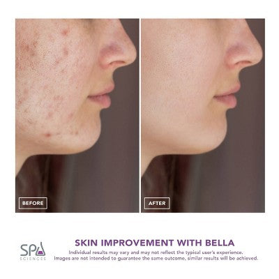Spa Sciences BELLA 3-in-1 Diamond Tip Microdermabrasion System - Imperfect Box by This is Beauty US