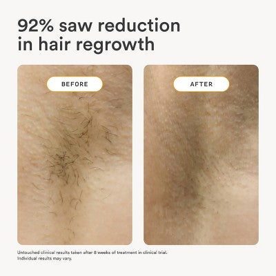 Nood The Flasher 2.0 IPL Permanent Hair Removal - Imperfect Box by This is Beauty US