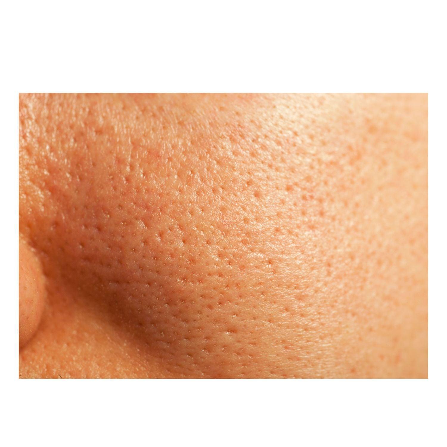 Thick As Thieves Pure Glycolic Acid Lactic Acid Extreme Gel Peel - 30ml by gymsegbë