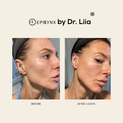 Pore Refining &amp; Redness Relief Serum – Vegan, Gluten-Free, Hypoallergenic Brightening Formula by EpiLynx