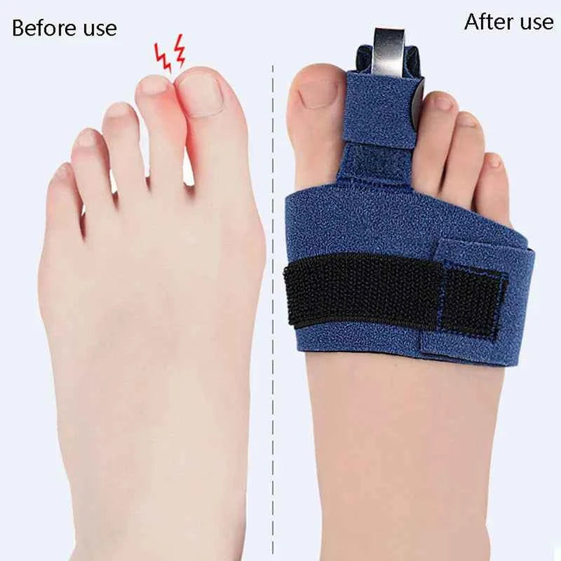 BunioFix™ Toe Corrector – Adjustable Bunion Relief &amp; Comfort Support