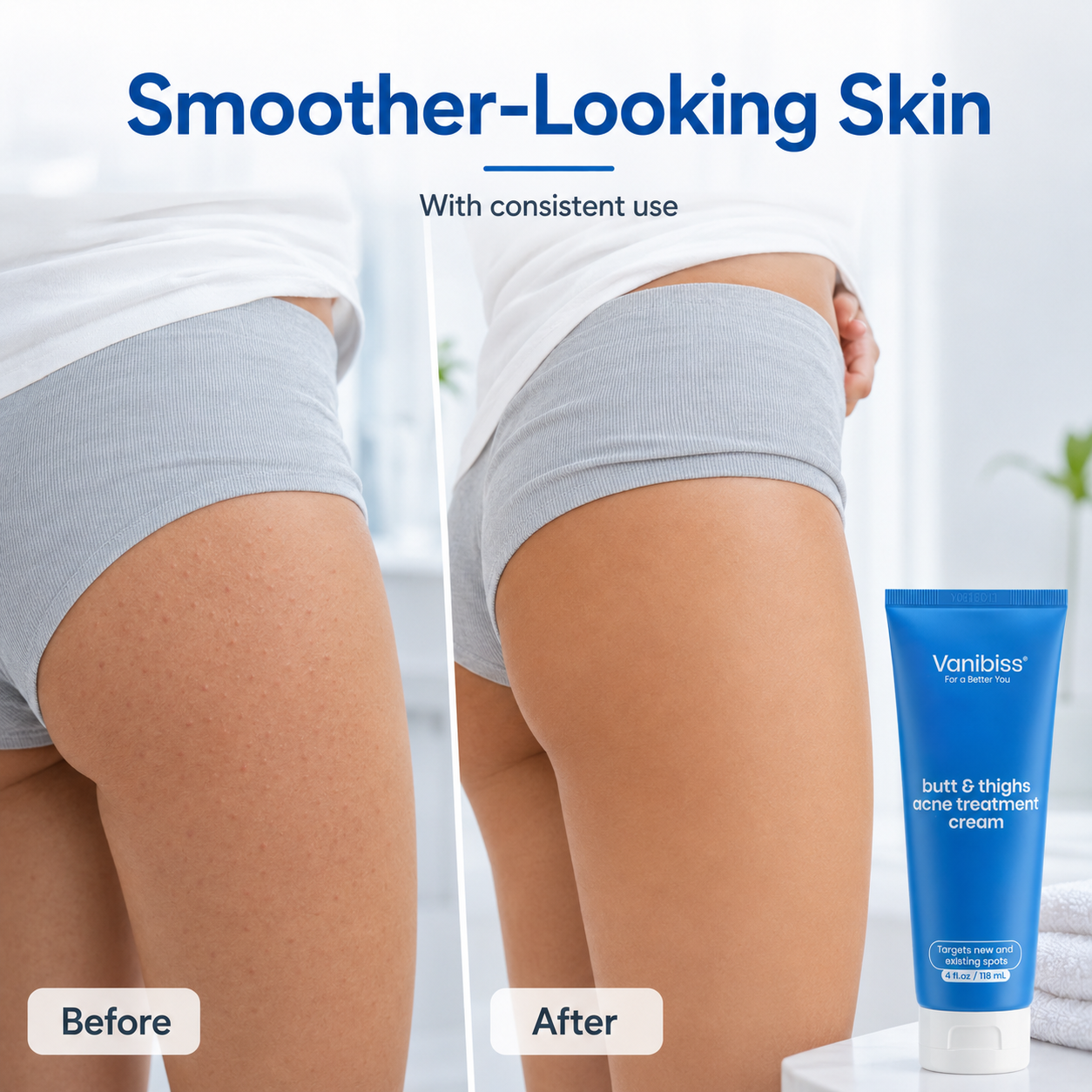 Butt &amp; Thighs Acne Treatment Cream by Vanibiss