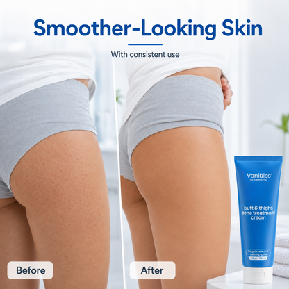 Butt &amp; Thighs Acne Treatment Cream by Vanibiss