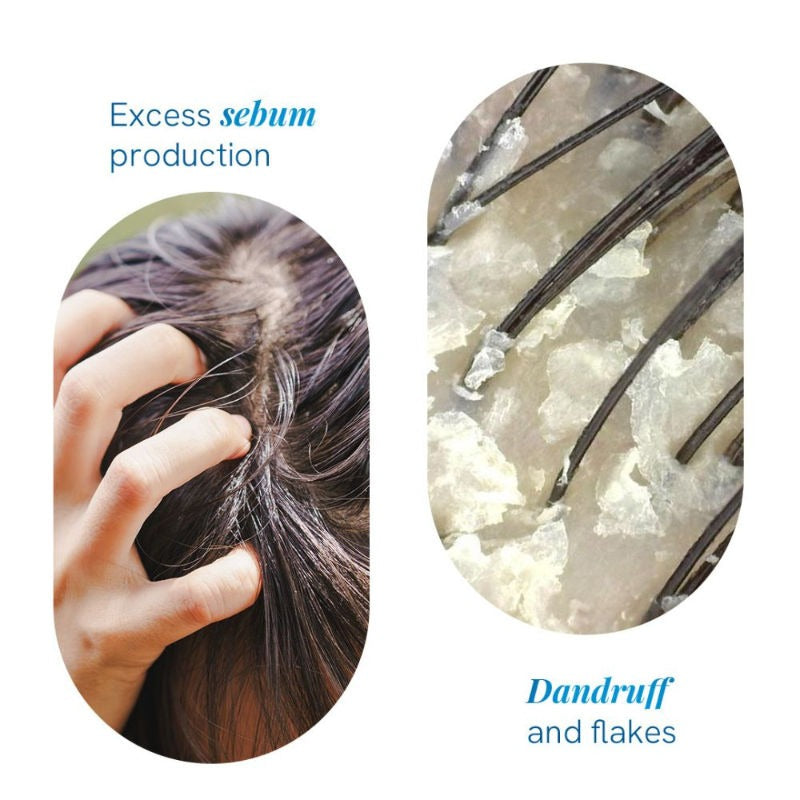 BeBodywise 1% Ketoconazole Dandruff Shampoo For Smooth &amp; Frizz Free Hair