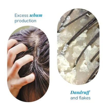 BeBodywise 1% Ketoconazole Dandruff Shampoo For Smooth &amp; Frizz Free Hair