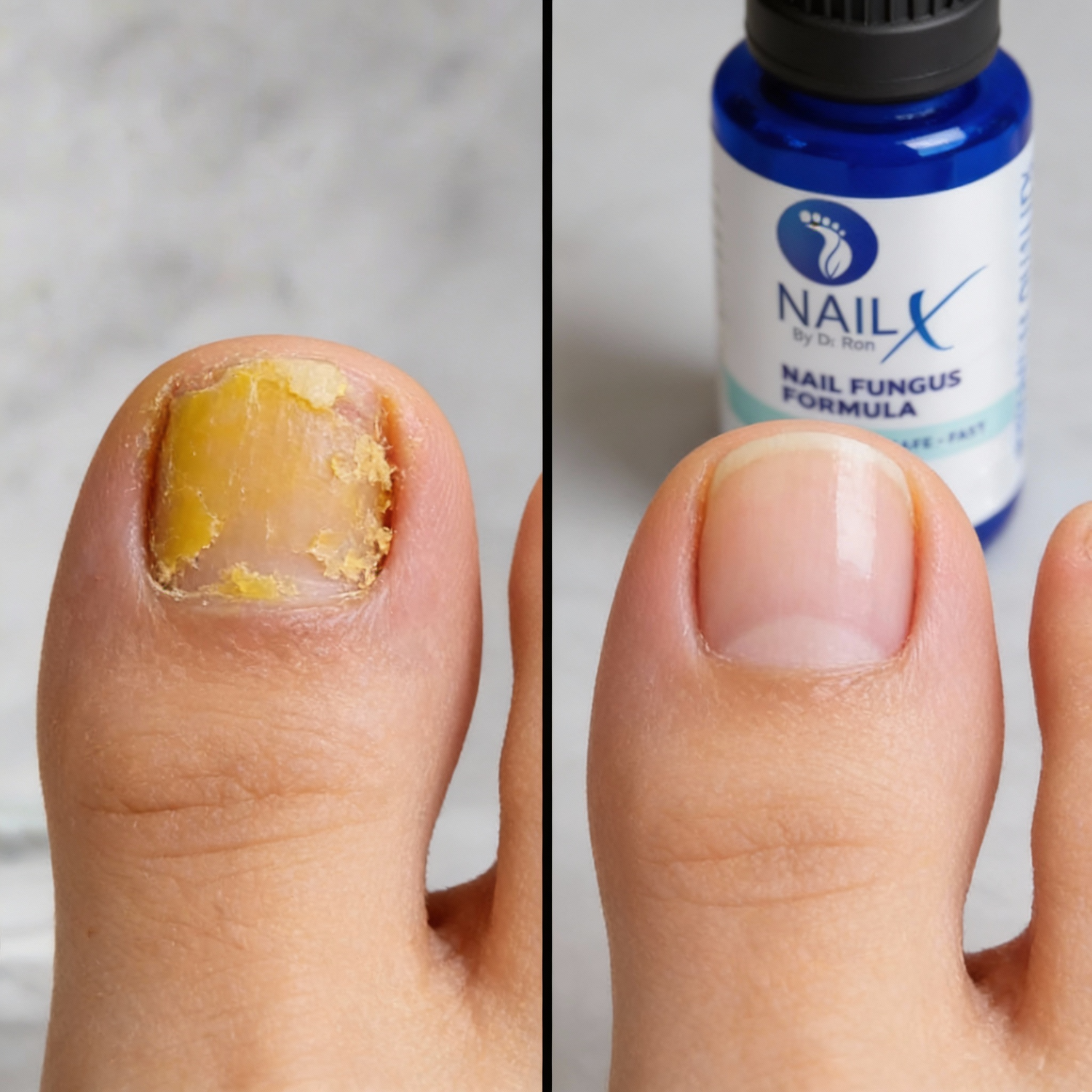 NailX Topical Nail Solution – Repair for Discolored, Damaged &amp; Fungal-Prone Nails