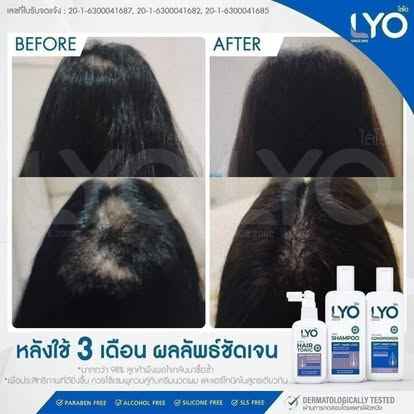 LYO Shampoo Conditioner Hair Tonic Treatment Hair Strengthen &amp; Regrowth