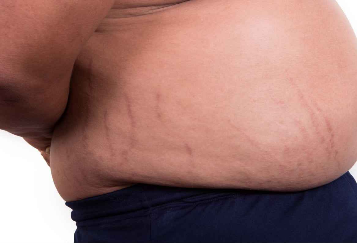 V2 Revolution Stretch Mark &amp; Cellulite Solution