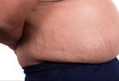 V2 Revolution Stretch Mark &amp; Cellulite Solution