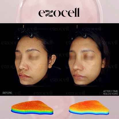 EXOCELL Exosome Rejuvenation Ampoule Stem Cell Power Bottle